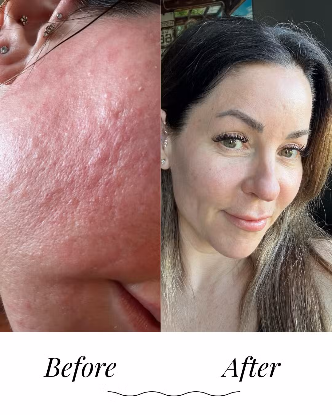 Hormone-Safe Skincare for Post-Procedure Recovery